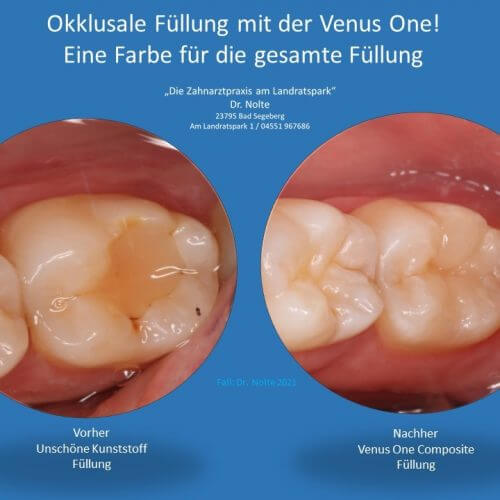 Zahnfüllungen - hochwertige Kompositfüllung